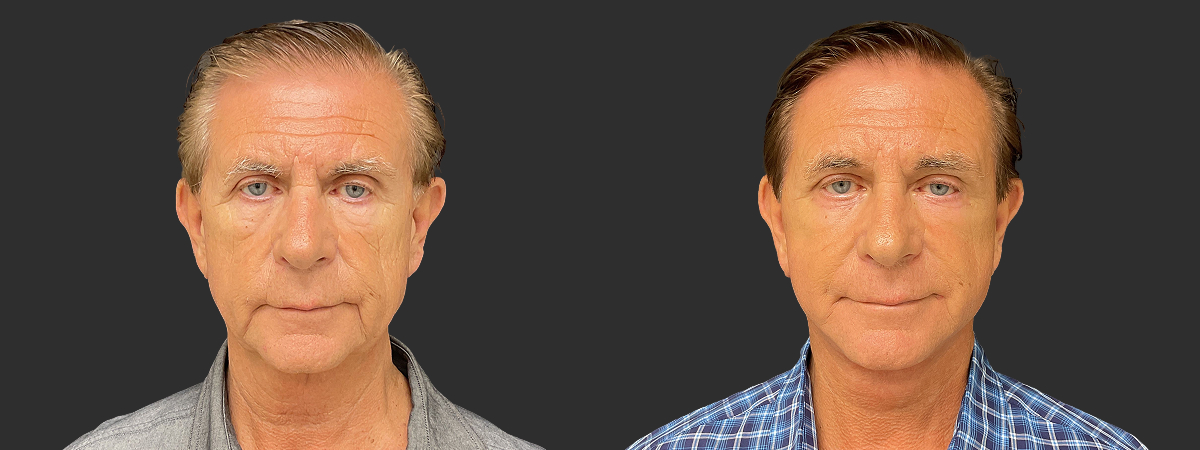 Before and after face and neck lift, front view – case 8