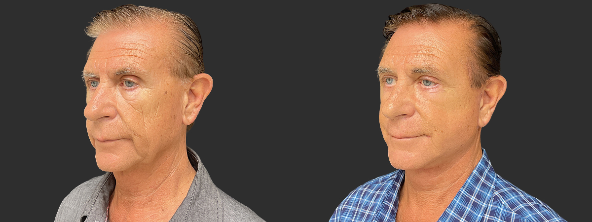 Before and after face and neck lift, left oblique view – case 8