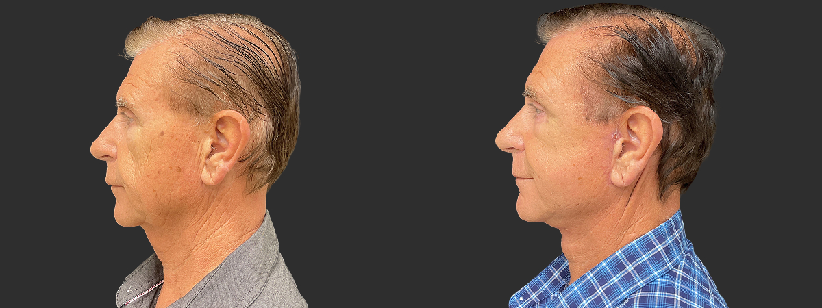 Before and after face and neck lift, left side view – case 8
