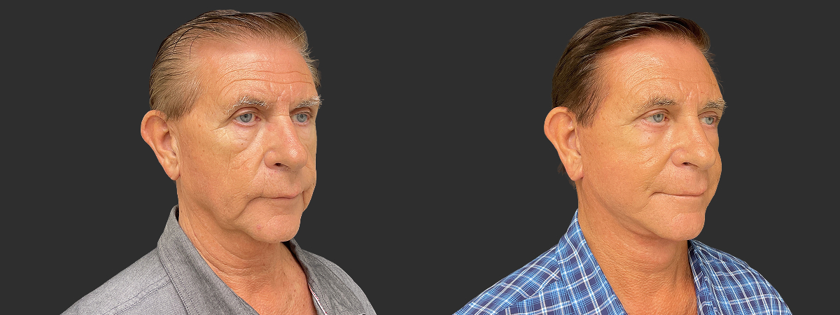 Before and after face and neck lift, right oblique view – case 8