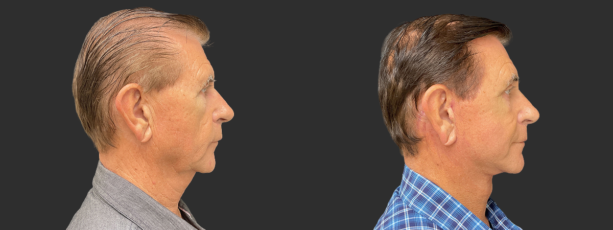 Before and after face and neck lift, right side view – case 8