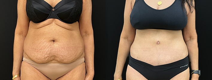 Abdominoplasty / tummy tuck results, front view – case 25