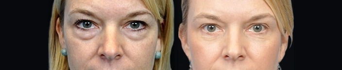Blepharoplasty results, front view – case 11