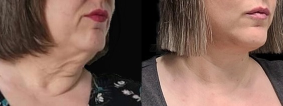 Neck lift results – case 5