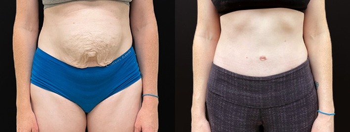 Abdominoplasty / tummy tuck results, front view – case 26
