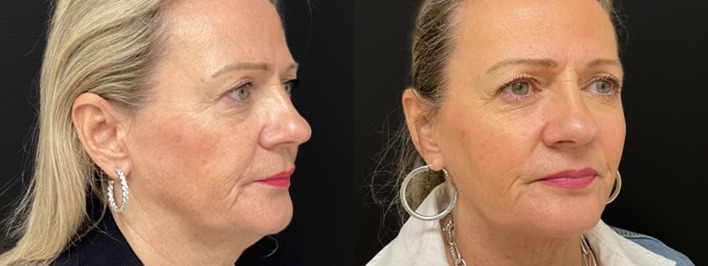 Neck lift results, right angle view – case 4
