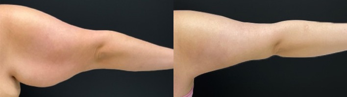 Arm lift results, back view – case 5