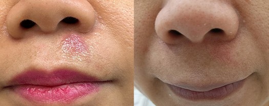 Cyst removal results – case 1, photo 3