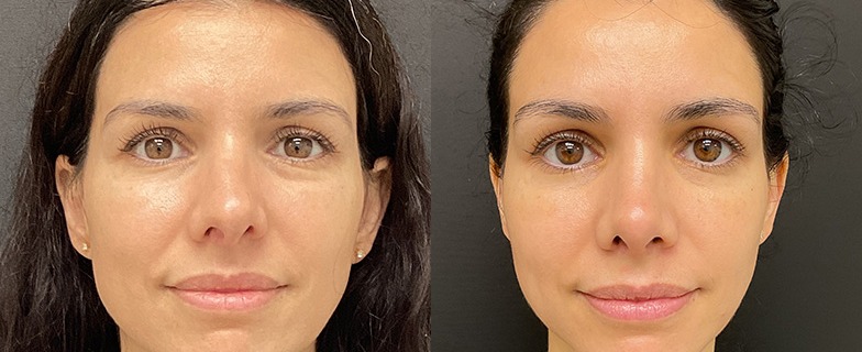 Rhinoplasty results, front view – case 7