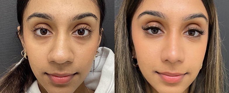 Rhinoplasty results, front view – case 6