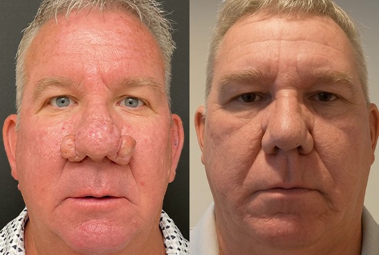 Rhinophyma results, front view – case 1
