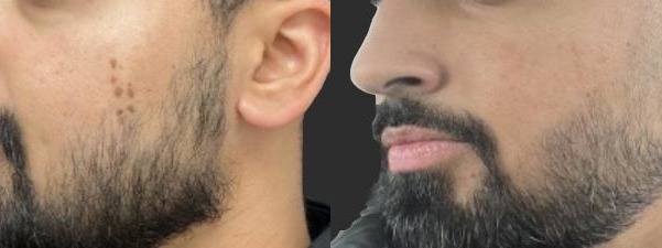 Seborrheic keratosis results – case 4