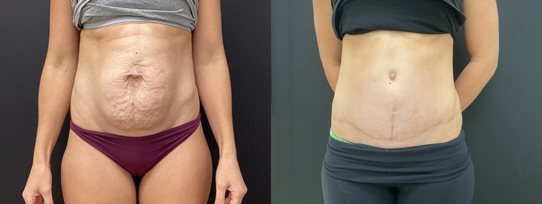 Abdominoplasty / tummy tuck results, front view – case 17