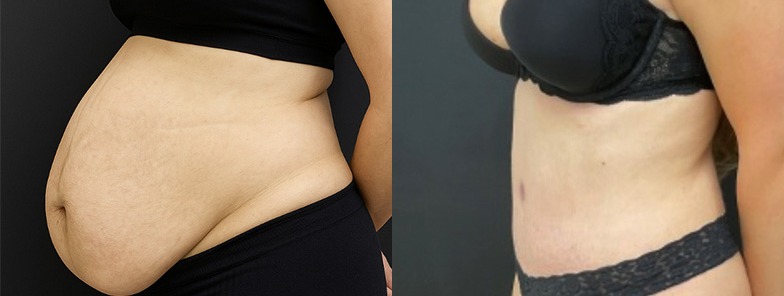 Abdominoplasty / tummy tuck results, profile view – case 18