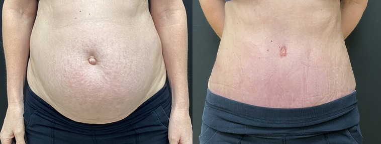 Abdominoplasty / tummy tuck results, front view – case 23
