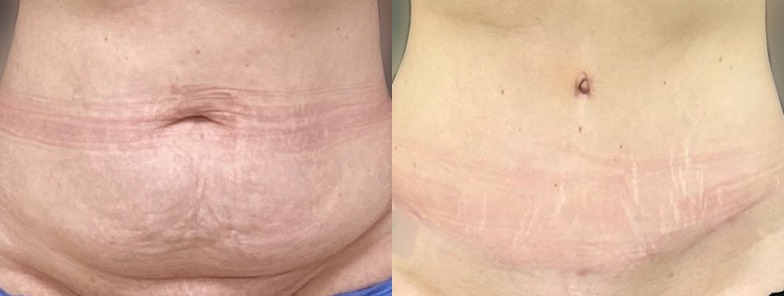 Abdominoplasty / tummy tuck results, front view – case 24