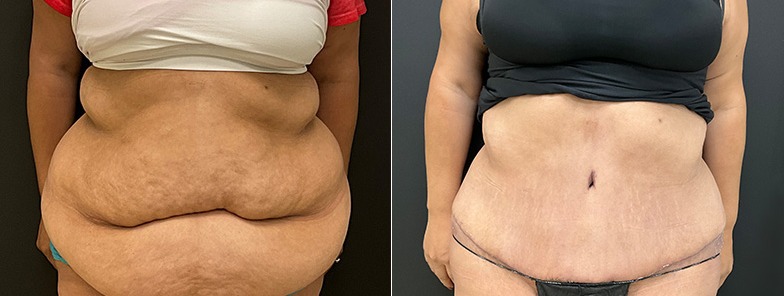 Abdominoplasty / tummy tuck results, front view – case 15