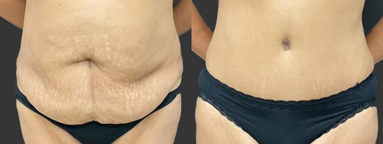 Abdominoplasty / tummy tuck results, front view – case 29