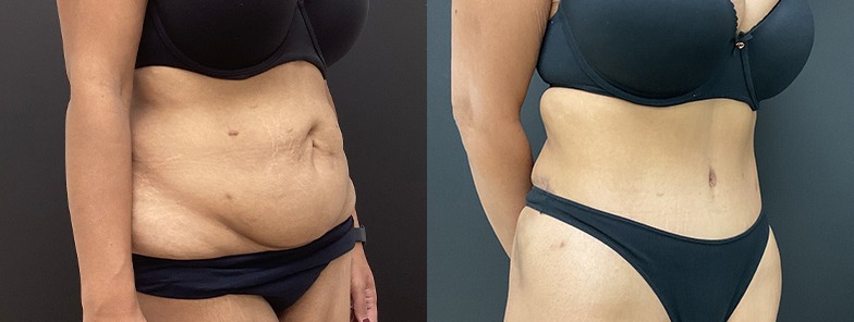 Abdominoplasty / tummy tuck results, angle view – case 16