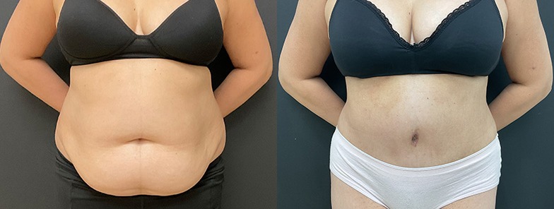 Abdominoplasty / tummy tuck results, front view – case 22