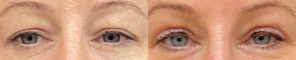 Upper blepharoplasty results – case 1
