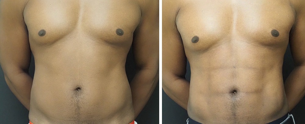 Abdominal etching & liposuction results, front view – case 1