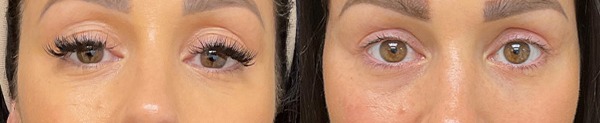 Blepharoplasty results – case 19, photo 2