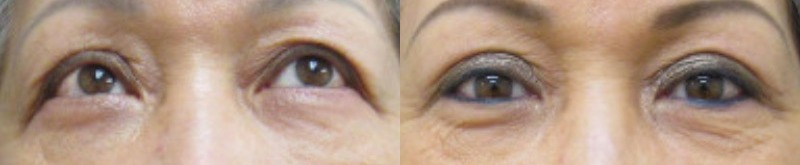 Blepharoplasty results – case 20