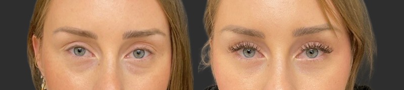 Blepharoplasty results, front view – case 24