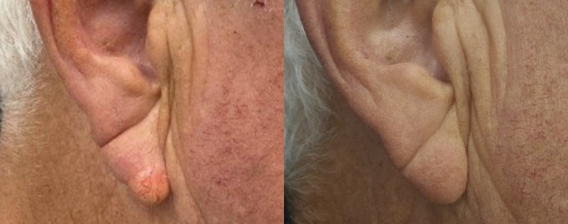before and after lumps + bumps