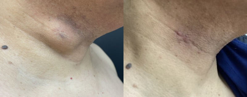 before and after lumps + bumps