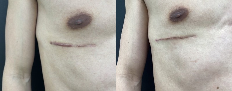 before and after lumps + bumps