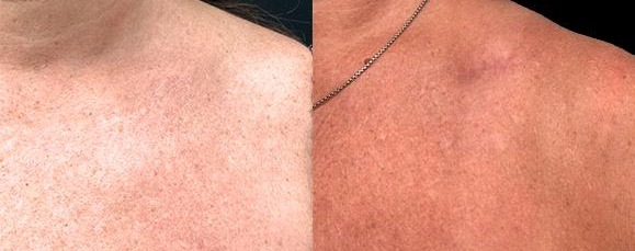 before and after minor surgery